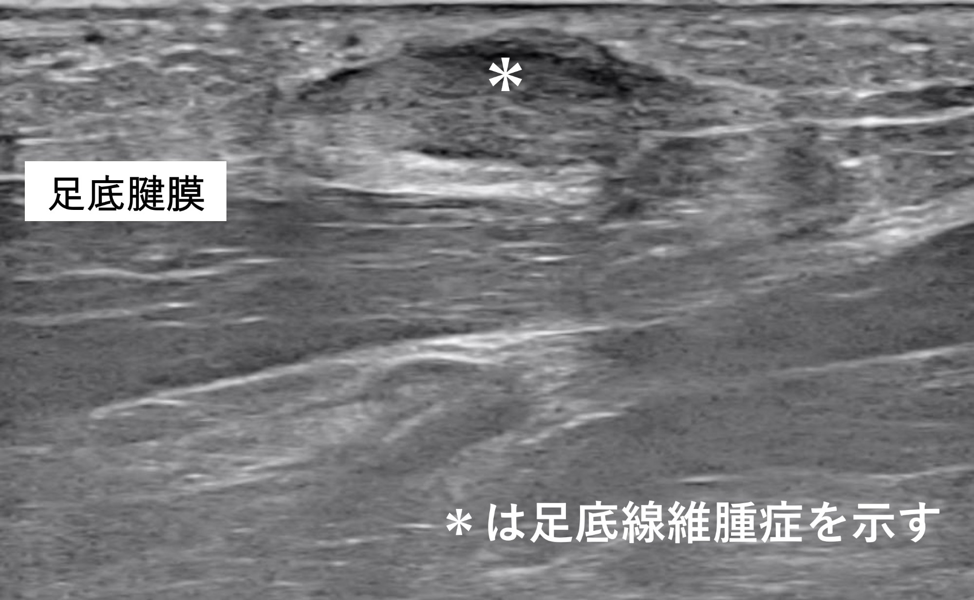 足底腱膜線維腫症の超音波画像