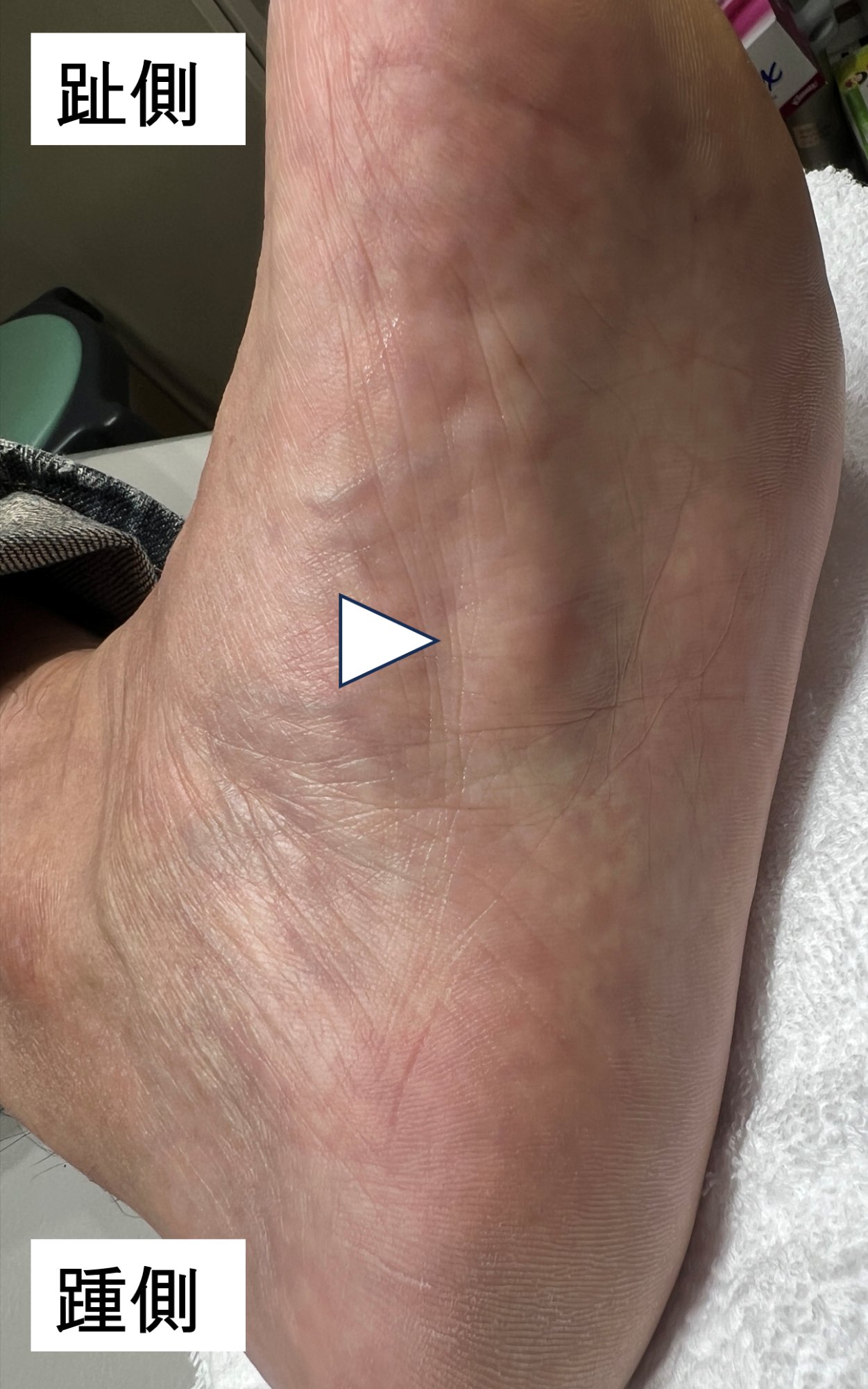 足底腱膜線維腫症の外観写真（足底部の腫瘤）