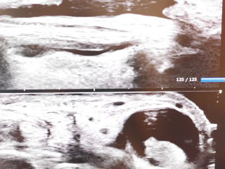 肩腱板エコー画像